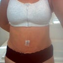 this is a picture now 9 days post op.