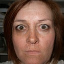 After blue peel