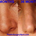 this is not my nose but finding this picture not long after I had my surgery really made me feel a lot better about my results when I was in a slump haha