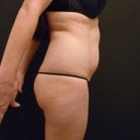 Before. Pictures provided by Simon Lee Aesthetic clinic