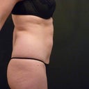 Six weeks after. Pictures provided by Simon Lee Aesthetic clinic