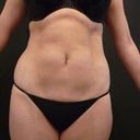 Six weeks after. Pictures provided by Simon Lee Aesthetic clinic