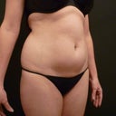 Before. Pictures provided by Simon Lee Aesthetic clinic