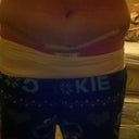 17 days po. Think I look more swollen here than I did at the 6 day po. photo before it.