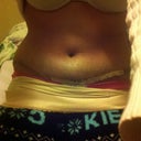 17 days. how it looks sitting down..so lumpy from seroma!