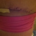 incision on the left hip. 17 days.