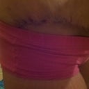 incision on right hip. 17 days.