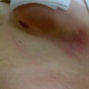 Some Bruising on Left Breast..