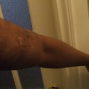 The arm before the treatment