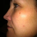 Just about 2 weeks after first photofacial. The large dark mark on the cheek bone I've had all my life and I'm keeping it.