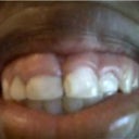 Before cosmetic crown lengthening