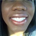 After cosmetic crown lengthening and whitening