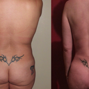 43 Year Old Female With Liposuction And Fat Grafting