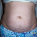 before surgery