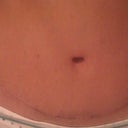 My scar at 3 months