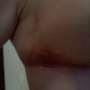 Day 5 - Bruising