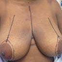 Getting ready for surgery looking at the indentions on my shoulders a lot of pain there