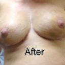 Dr Mackenzie is an awesome plastic surgeon. Check out his stitch work. They are totally invisible.