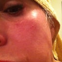 Post procedure. Day 4