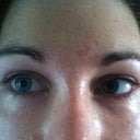 Another DURING TREATMENT photo. Eyes felt dry and often itchy. It was like the Hyaluronidase caused allergic symptoms for 2 weeks after each treatment. My eyes would water, but be dry and burning. Still puffy here after 5 months of Hyaluronidase injections, but overall bulging way reduced from what it was