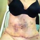 Day 9 post op