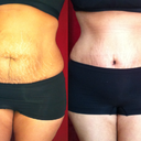 2 weeks Post op:)  still swollen my before and after.. i had way too many stretch marks to begin with so dont mind it:)