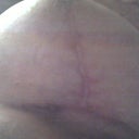 9 Weeks PO L Breast.