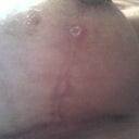 9 Weeks PO R Breast.  The white circle is where the hole was.  The other mark on the side of my boob is a mark my bra made. ;-)