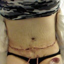 Love how flat my stomach is already. 1 day post op
