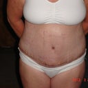 9 days post op....front view....keep in mind I am swollen