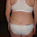 9 days rear view....no more back fat!!
