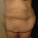 Preop. 100lb weight loss after 3 kids.