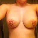 Day 4 post op