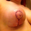 Underside of right breast