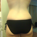 back pre-op. The love handles that he wants to lipo to keep from getting dog ears