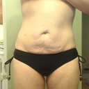 pre-op. Bikini bottom I hope to look good in after tt