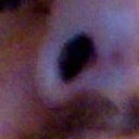 Tiny mark from open rhinoplasty