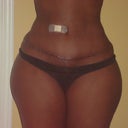 11 weeks post op TT incision healing well.