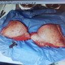 skin removed durring tummy tuck