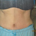 37 days po (swelling is going down)