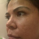 2 days post - This is my 2nd treatment