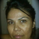 1wk prior to my 3rd Matrix RF Treatment