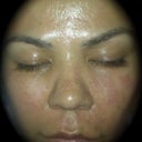 3rd treatment 9.2.09 (6hrs after)