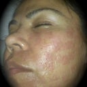 3rd treatment 9.2.09 (left side)