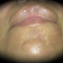 3rd treatment 9.2.09 (chin)