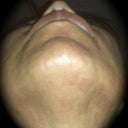 3rd treatment 9.2.09 (neck)