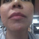 11.2 - I've been breaking out since my last treatment (Chin)
