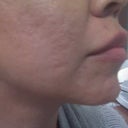 11.2 - left side (still very deep scars)