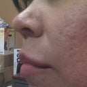 11.2 - Right Side (very visible scars)