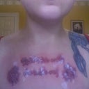 One day after 6th treatment. Looks gross! Sorry!